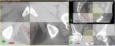 Post-Prostatectomy Image-Guided Radiotherapy: The Invisible Target Concept